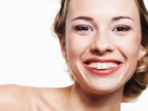 photodune-4465792-smile-with-dental-braces-s-555x358